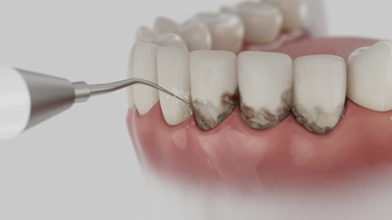 Trusted Wisdom Tooth Removal service in Galena Park, TX - Dentist Open Now